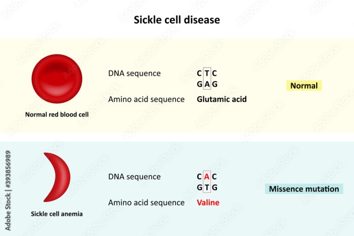 Nclex questions on sickle cell anemia