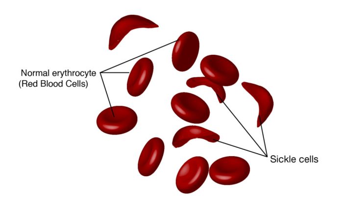 Nclex questions on sickle cell anemia