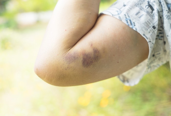 Early bruising following abdominal trauma often manifests as: